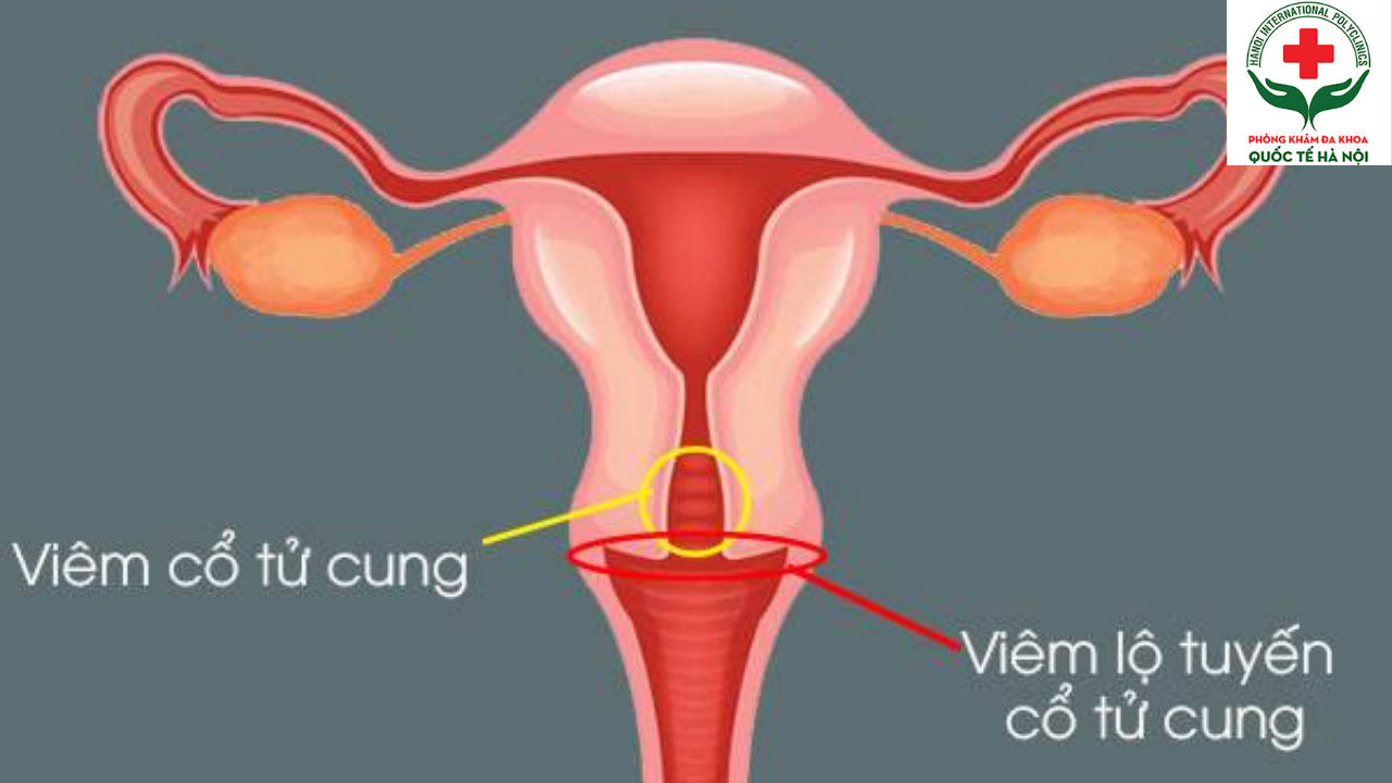tìm hiểu về cổ tử cung và các bệnh lý